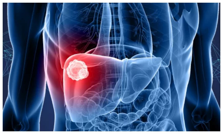 Liver Cancer: रिसर्च में हुआ बड़ा खुलासा, 2040 तक कैंसर से हो सकती है इतने लोगों की मौत