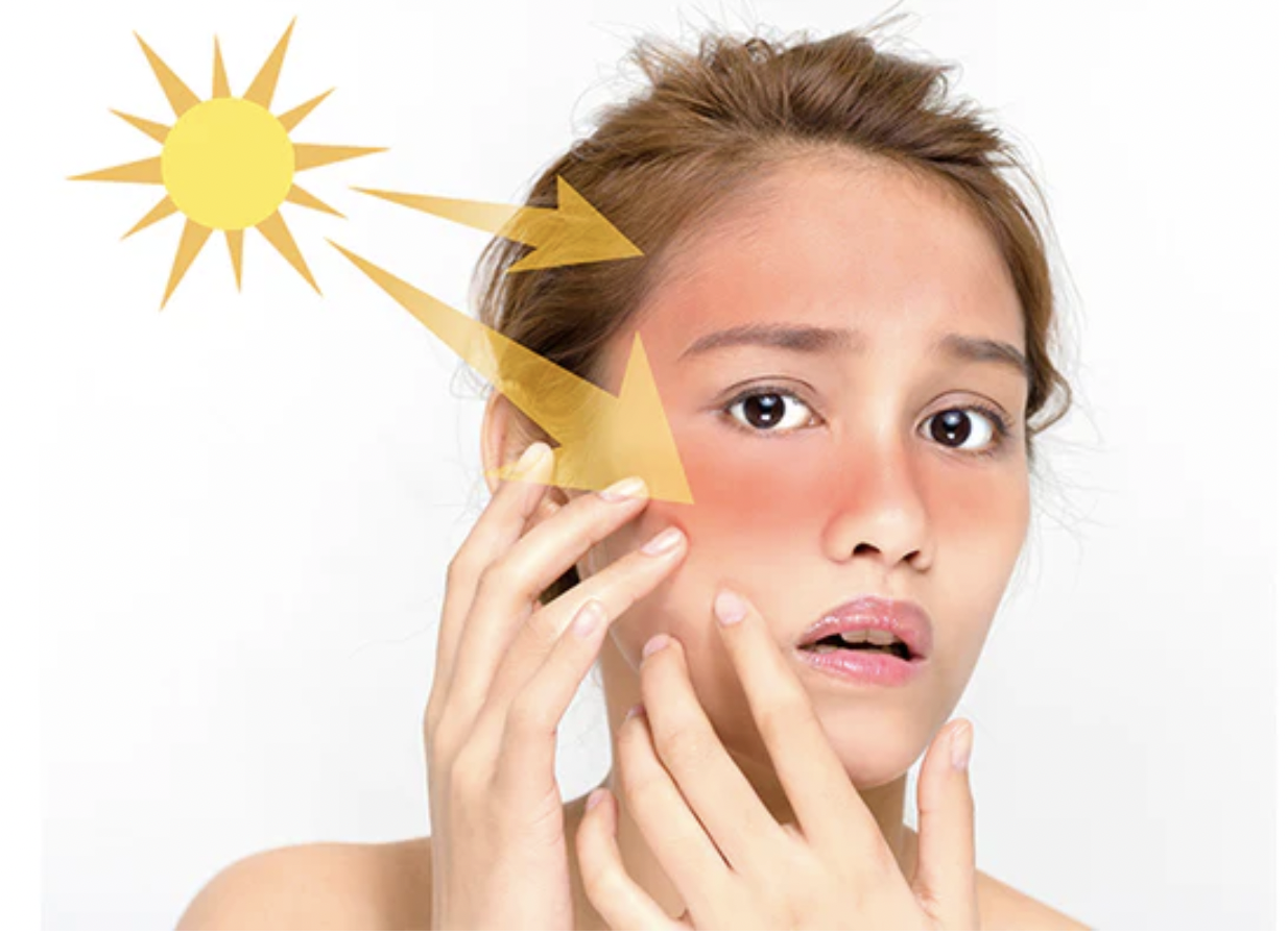 Sun Burn: धूप से झुलसी त्वचा? घरेलू नुस्खों से पाएं राहत, सनबर्न से छुटकारा पाने के आसान उपाय